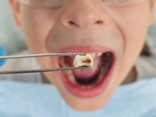 Best Emergency Wisdom Teeth Removal in Kettering, OH